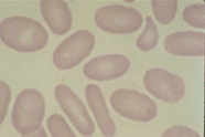 : : :  eliptocitose ou ovalocitose  : : :